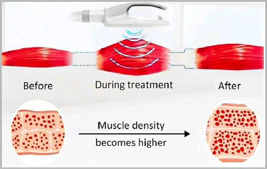 EMS MAXX Body Trim & Tone™ Device Aesthetics Depot image2 1 Aesthetics Depot