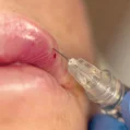 MicroCannula
