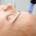 Microneedling